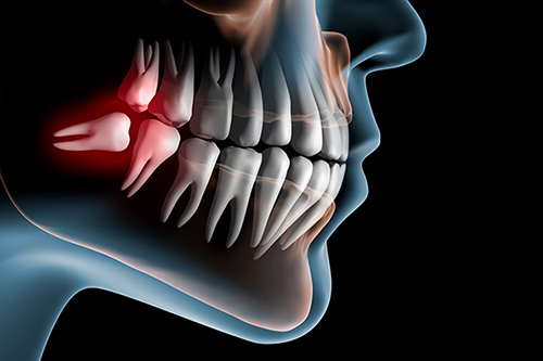 Wisdom Teeth taste